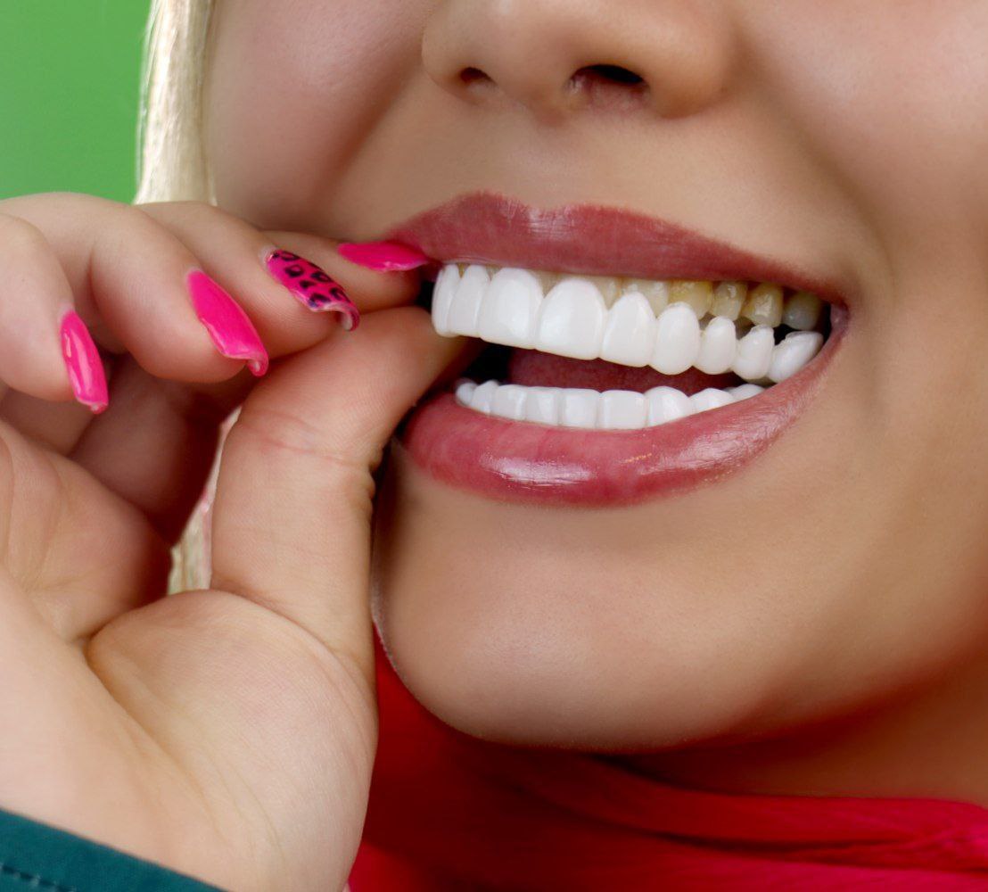  لمینت متحرک دندان دو فک اصلی