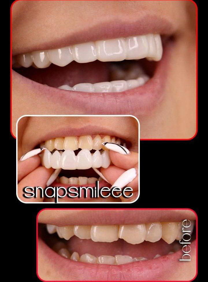  لمینت متحرک دندان دو فک آلمانی اصل